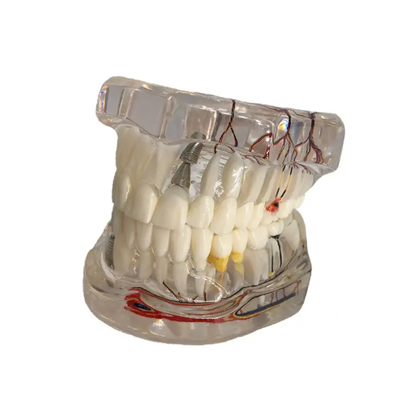 Модель зубов на зубном имплантате с реставрацией мостовидного зуба стоматологом для медицины