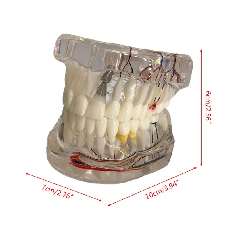 Модель зубов на зубном имплантате с реставрацией мостовидного зуба стоматологом для медицины 1