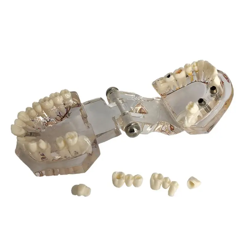 Модель зубов на зубном имплантате с реставрацией мостовидного зуба стоматологом для медицины 2