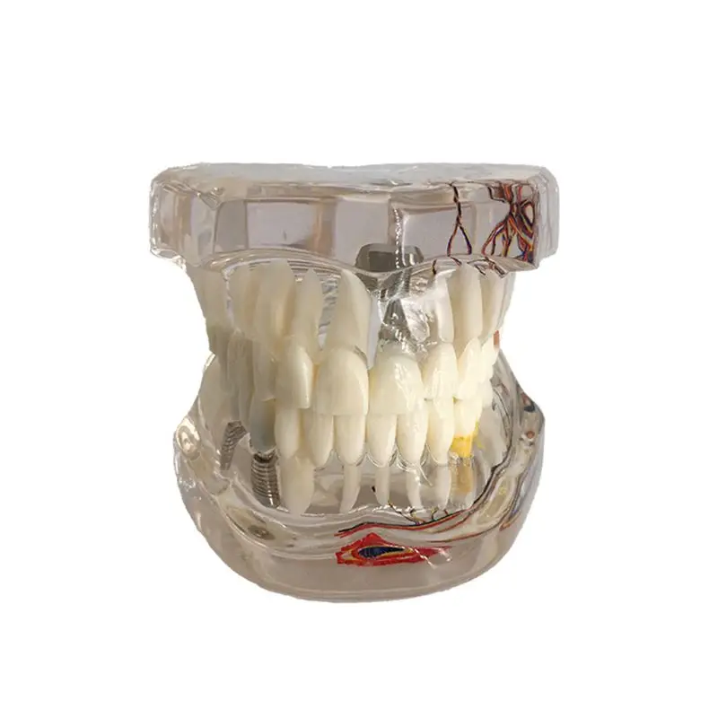 Модель зубов на зубном имплантате с реставрацией мостовидного зуба стоматологом для медицины 5