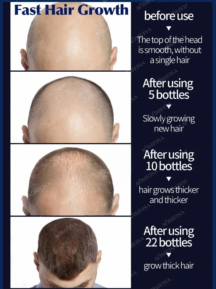 Эфирное масло для быстрого роста волос, восстановление облысения 5