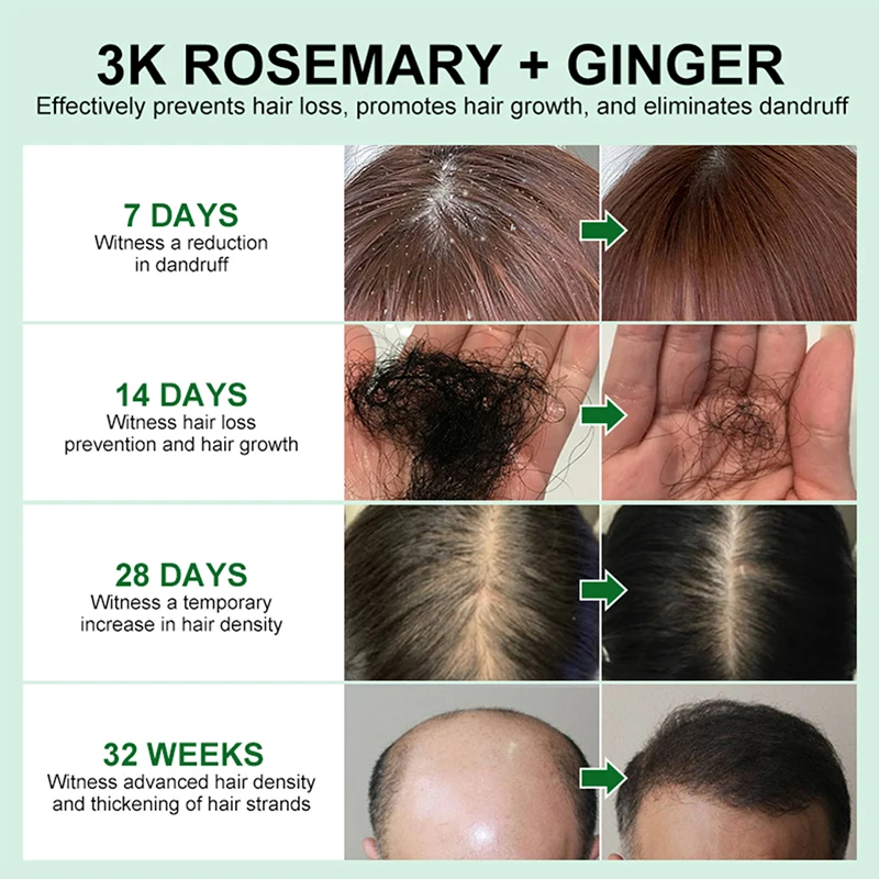 Эссенция для быстрого роста волос Восстановление против выпадения волос Уход за поврежденной кожей головы Питательные натуральные ингредиенты Уход за волосами Эфирное масло 1