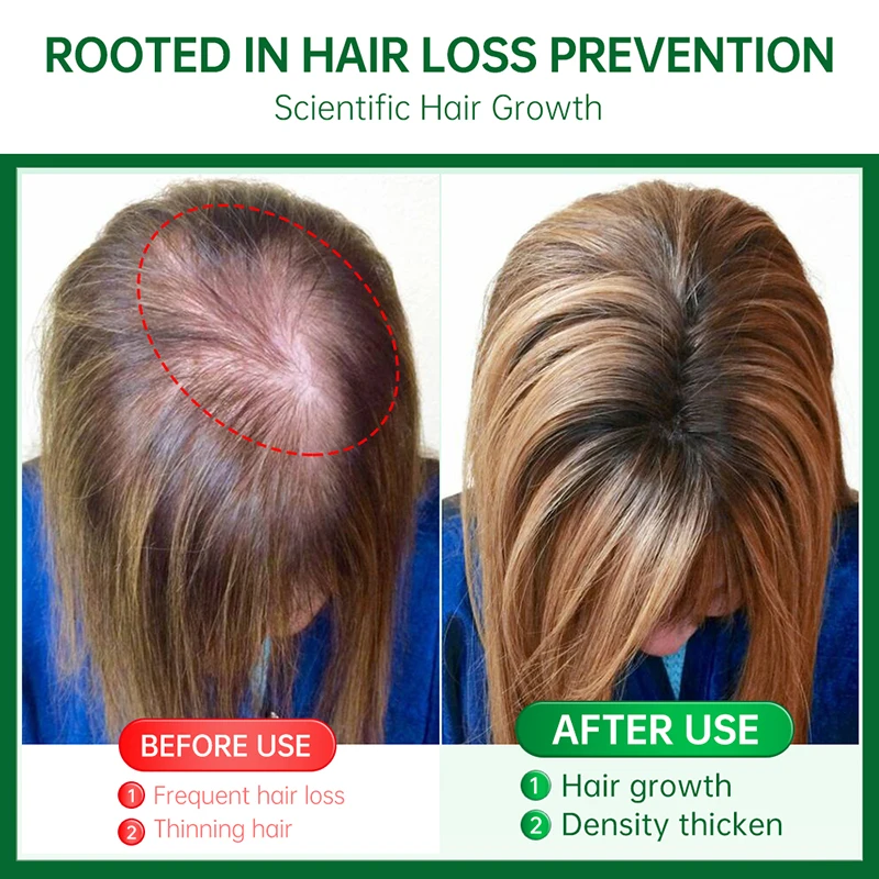 Эссенция для быстрого роста волос Восстановление против выпадения волос Уход за поврежденной кожей головы Питательные натуральные ингредиенты Уход за волосами Эфирное масло 3