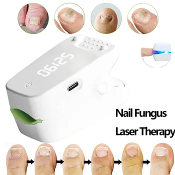 905 нм Грибок ногтей Лазерная терапия USB Ногти на ногах Ногти на ногах Машина для лечения онихомикоза Унисекс Инструменты для ухода за ногами