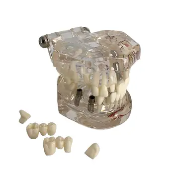 Модель зубов на зубном имплантате с реставрацией мостовидного зуба стоматологом для медицины 3