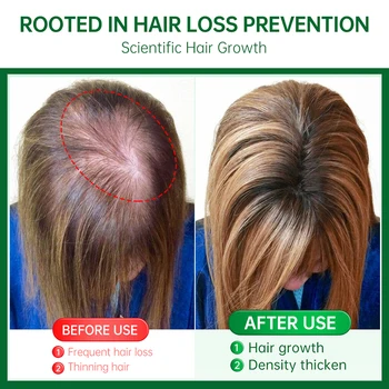 Эссенция для быстрого роста волос Восстановление против выпадения волос Уход за поврежденной кожей головы Питательные натуральные ингредиенты Уход за волосами Эфирное масло 3